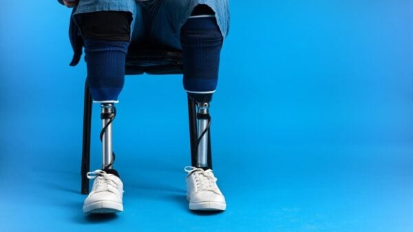 Ampute engelli raporu ve yasal haklar danışmanlık süreci