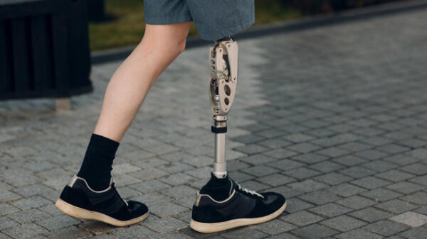A person adjusting their prosthetic leg liner for better comfort