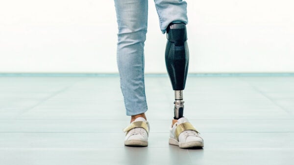 Klinik ortamında protez bacak uyum süreci ve yürüyüş analizi