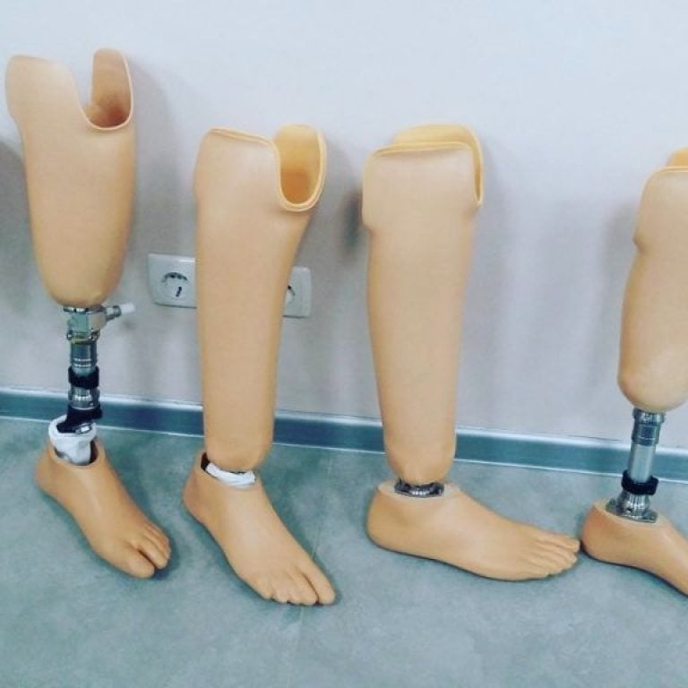 Professional prosthetic leg fitting process in a modern clinic