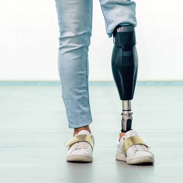 Klinik ortamında protez bacak uyum süreci ve yürüyüş analizi